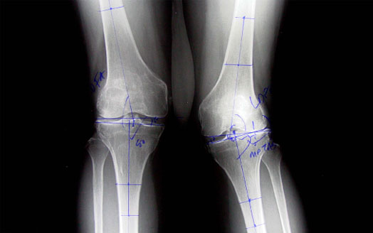 Rheumatoid arthritis and valgus deformity left knee