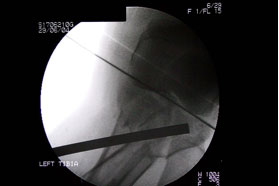 Punch inserted through tunnel and bone graft inserted