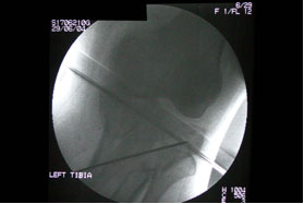 2<sup>nd</sup> wire inserted into elevated lateral tibial plateau