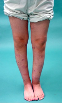 Bilateral Severe Leg Deformities After