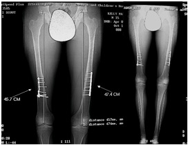 Tibia Lengthening with Fitbone