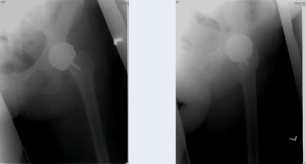 Hip Surface Replacement