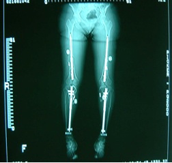 2 Fitbone nails in femur and 2 Fitbone nails inserted in tibia at one surgery