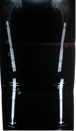 3cm length in both femur and 5cm length gain in  both tibia  obtained with callus formation