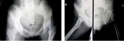 avascular necrosis hips from chronic steroid ingestion