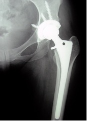 Total hip replacement through minimally invasive single incision