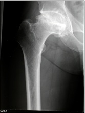65 years old male with pain and limping right hip due to osteoarthritis