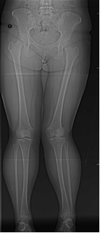 valgus deformity left knee