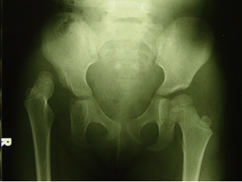 4 year old child with right Development Dysplasia of the Hip (DDH)