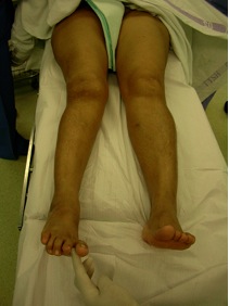 Valgus right leg with 3 cm shortening in 41 year old Indian female
