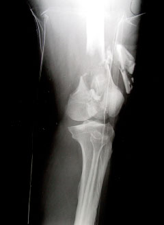 fracture femur