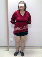 Happy patient with good pain relief and knee motion