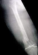 malunion and knee osteoarthritis