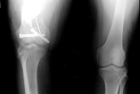 intra-articular correction and knee replacement