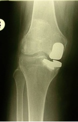 failed Unilateral Knee Replacement