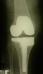 X-rays showing TKR implant with good alignment