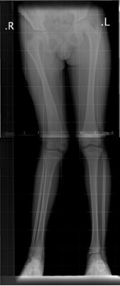 Preop unilateral right knock knee deformity