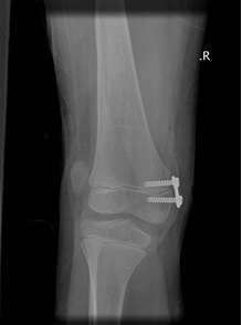 8-plate inserted to distal femur