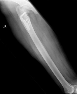 3 cm shortening femur secondary to coxa vara