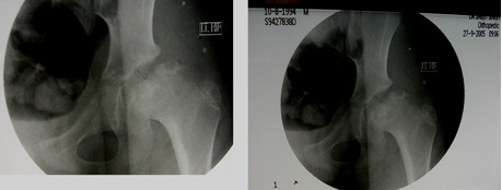 9 year old boy with Salter type B Perthes disease hip and lateral subluxation