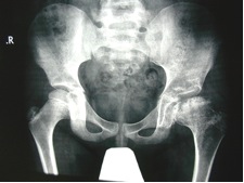 Good hip remodeling and symptomatic improvement of hip