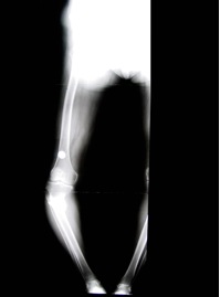 Hypertrophic non-union tibia with deformity