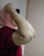 Good relief of elbow pain and excellent function