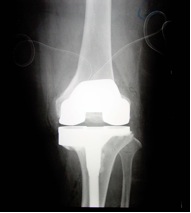 Underwent bilateral knee replacements