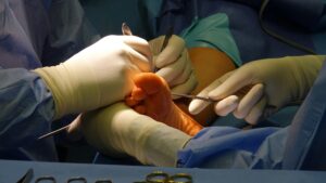 Surgeons in sterile gloves performing foot surgery, using tools on a patient's foot beneath blue drapes